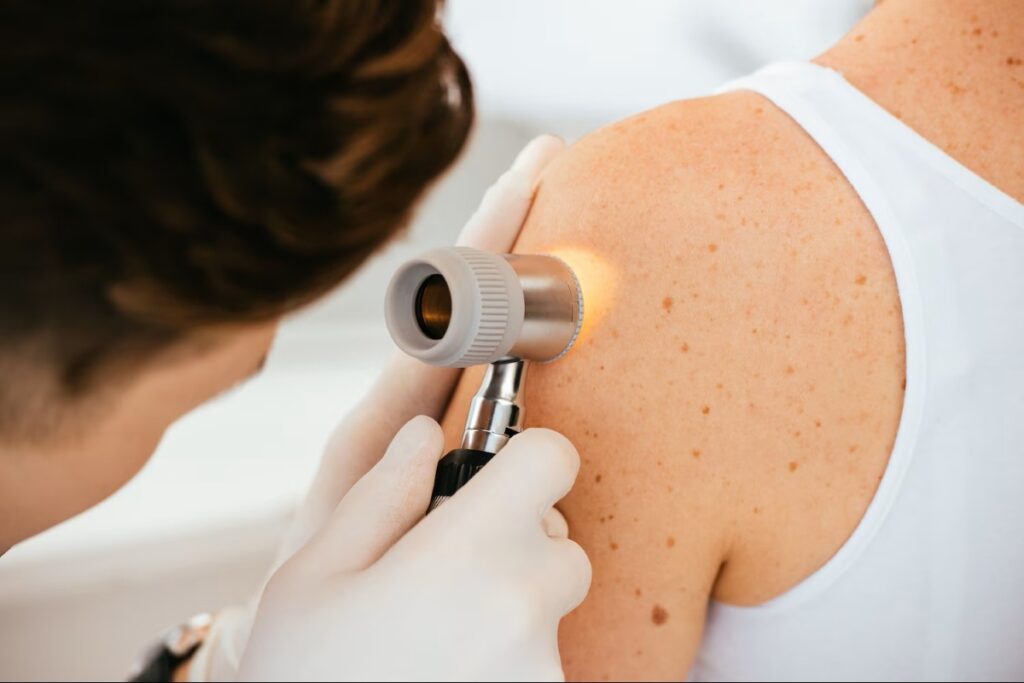 Melanoma, il vaccino a mRNA personalizzato riduce del 42% il rischio di recidiva e decesso